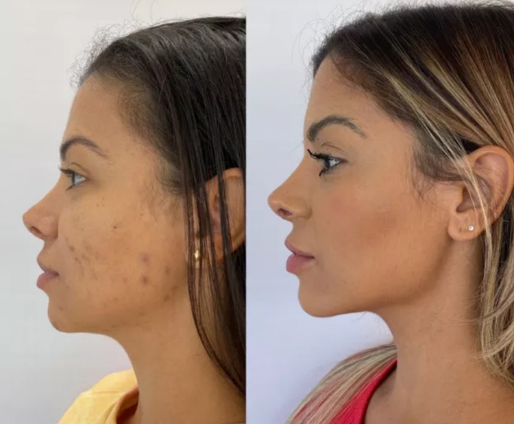 Antes e depois · harmonização